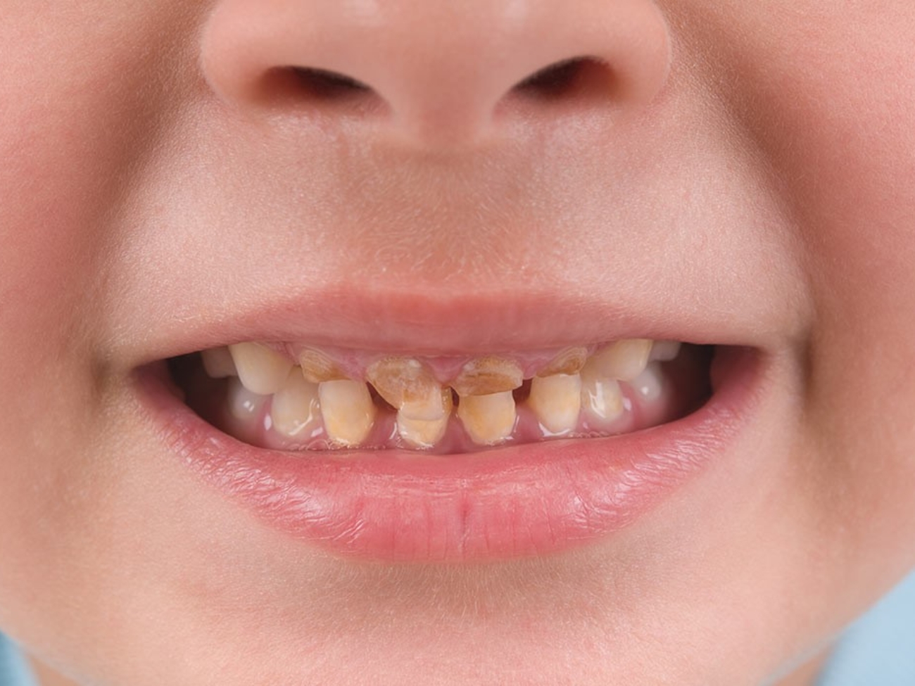 از بین بردن لکه های سیاه روی دندان کودک