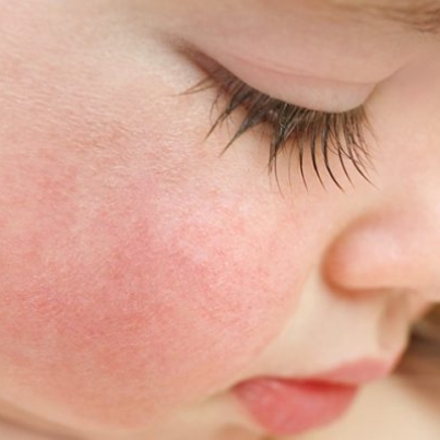 5 بیماری پوستی در کودکان