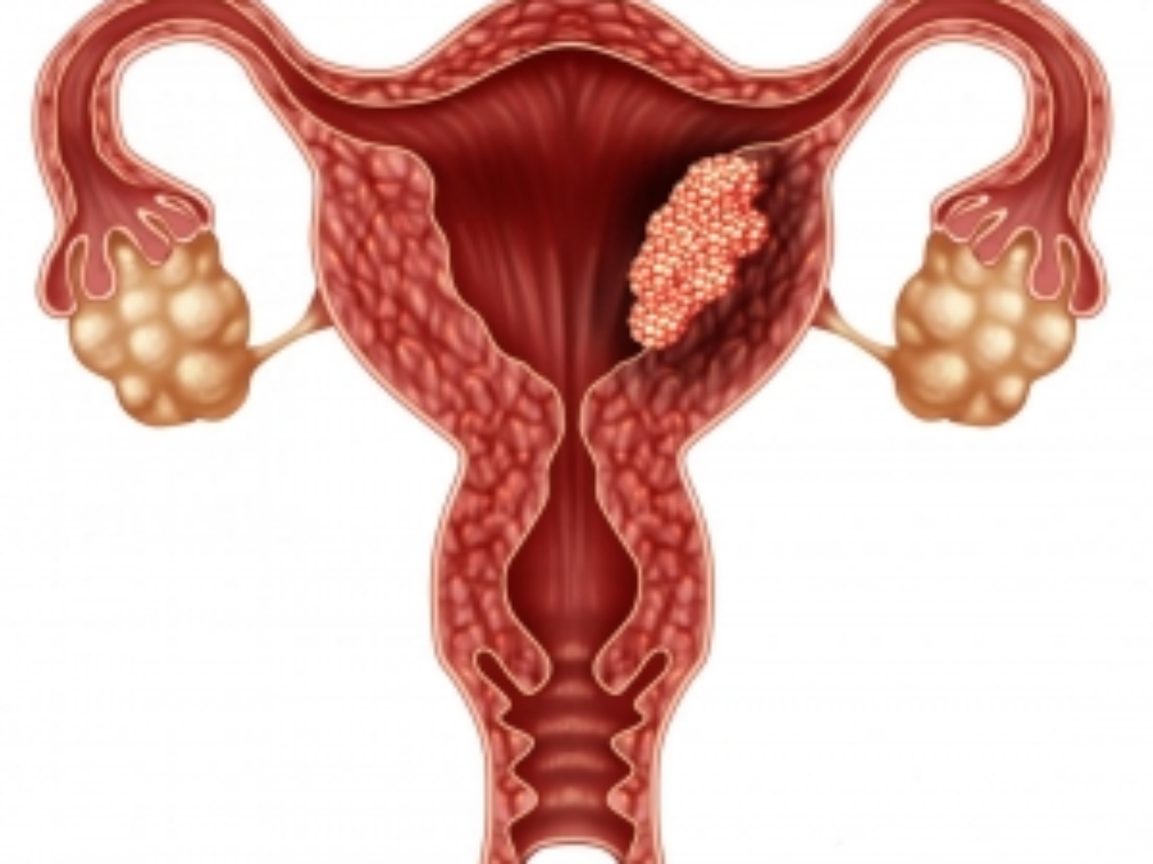 14 شرایطی که باعث ایجاد توده در واژن می شود