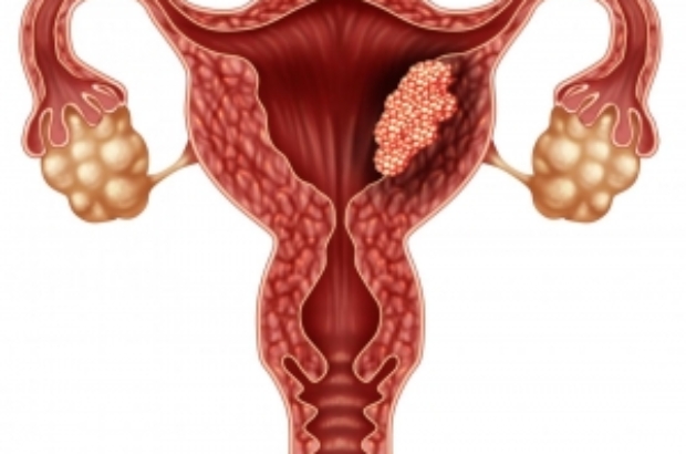 14 شرایطی که باعث ایجاد توده در واژن می شود